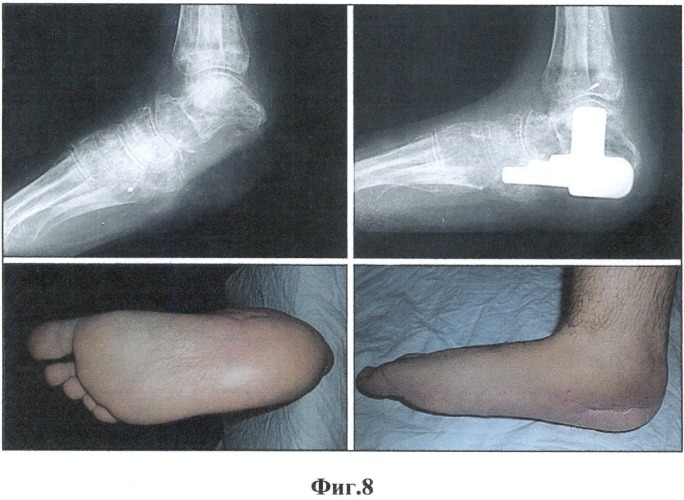 Эндопротез пяточной кости (патент 2515391)