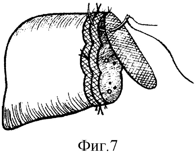 Способ резекции печени (патент 2278617)