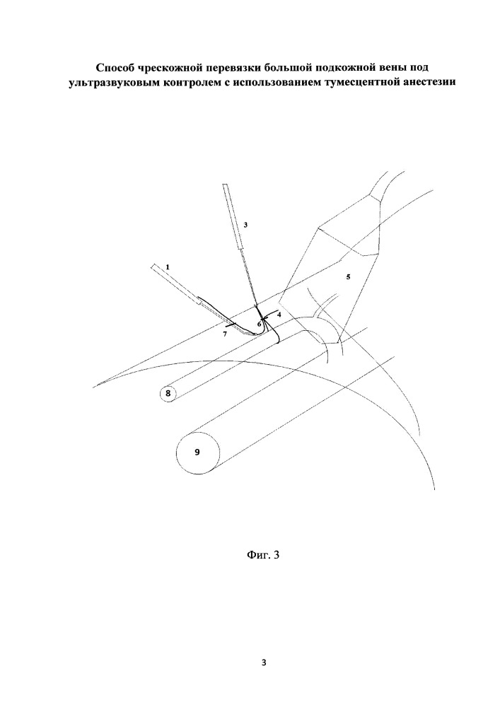 Способ чрескожной перевязки большой подкожной вены под ультразвуковым контролем с использованием тумесцентной анестезии (патент 2651081)