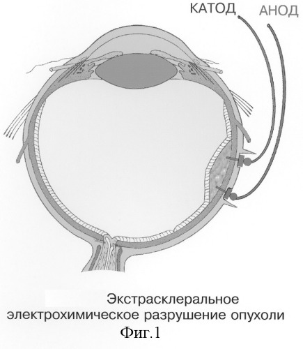 Способ электрохимической деструкции, хирургического удаления и фотодинамической профилактики рецидивов внутриглазных новообразований (варианты) (патент 2244531)