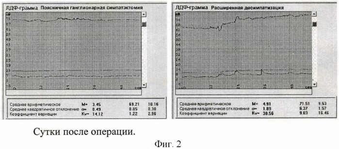 Способ комбинированной десимпатизации у больных с хронической ишемией нижних конечностей (патент 2441603)
