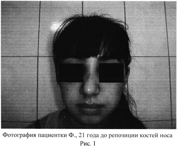 Способ превентивной терапии ринальных осложнений после травмы носа (патент 2559587)