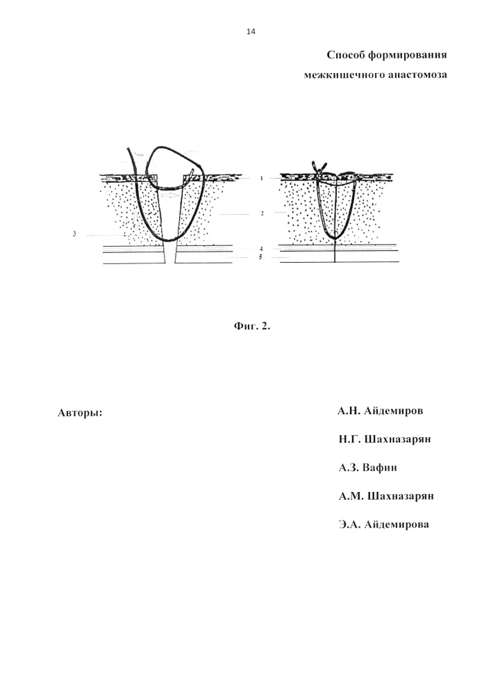 Способ формирования межкишечного анастомоза (патент 2663648)