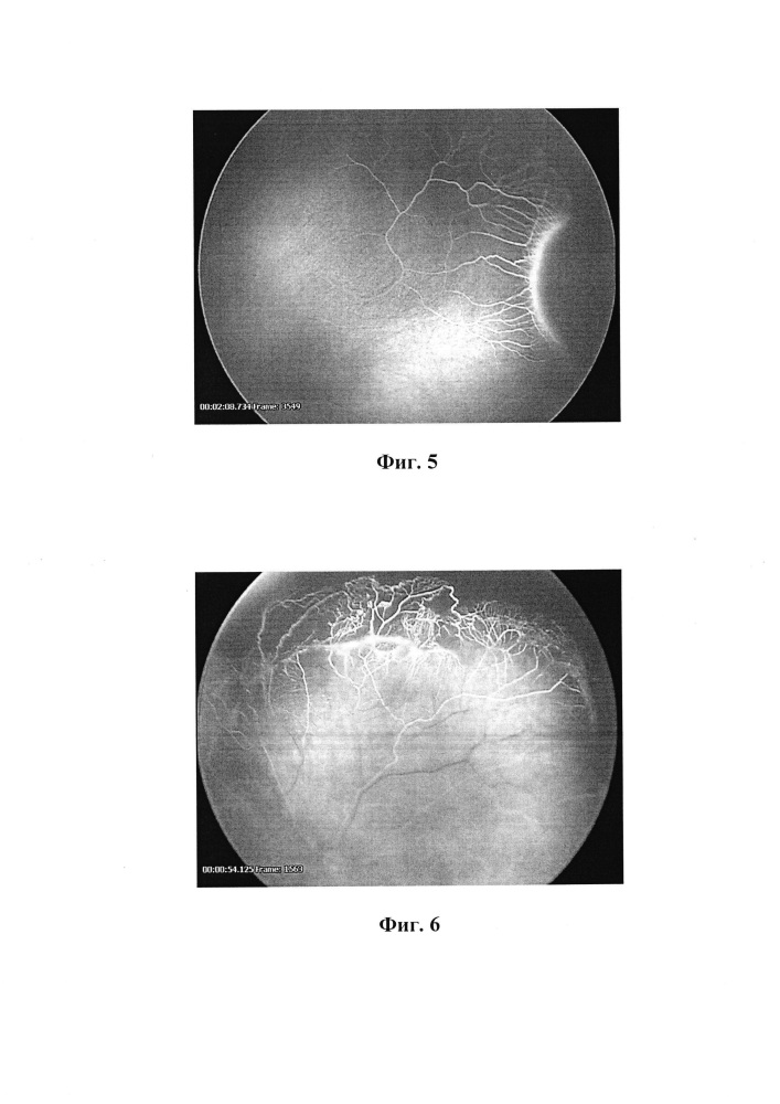 Способ прогнозирования течения i-iii стадий активной ретинопатии недоношенных на основании данных флюоресцентной ангиографии (патент 2666268)