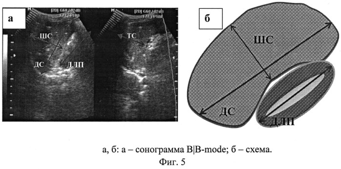 Способ ультразвуковой диагностики воспалительных изменений печени и селезенки при туберкулезе у детей (патент 2535613)