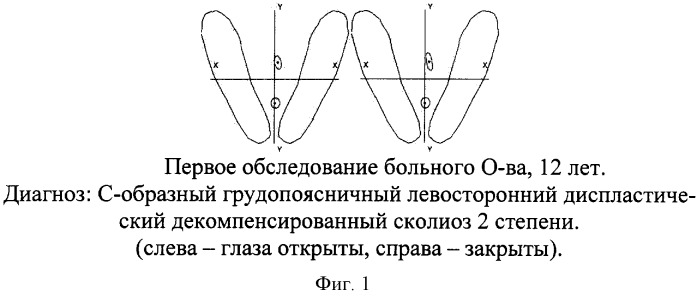 Способ прогнозирования прогрессирования сколиотической деформации (патент 2302818)