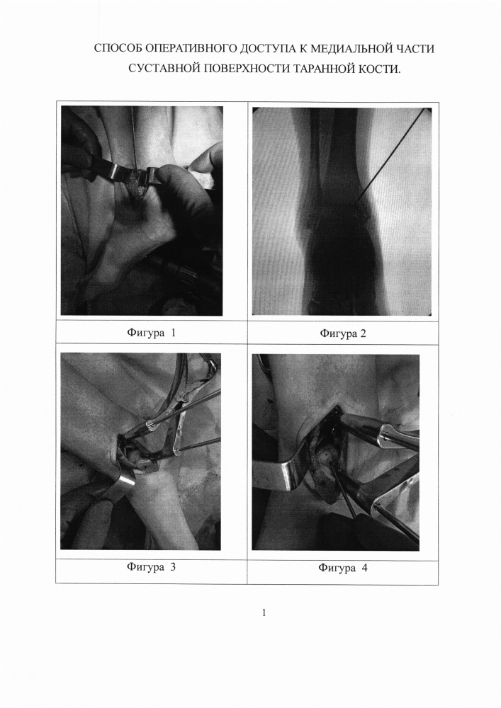 Способ оперативного доступа к медиальной части суставной поверхности таранной кости (патент 2638280)