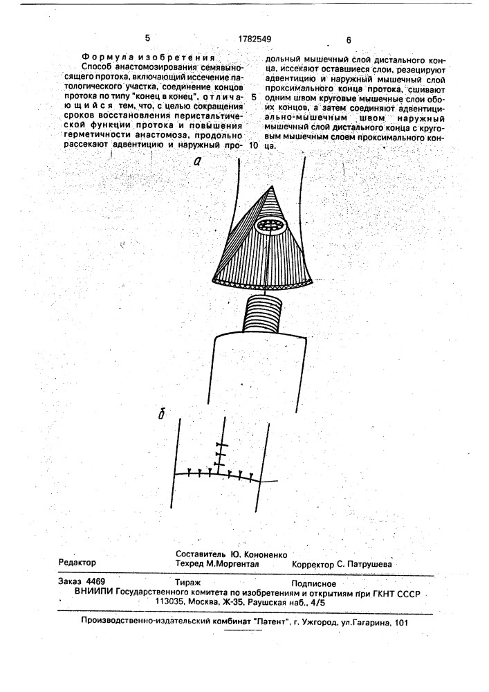 Способ анастомозирования семявыносящего протока (патент 1782549)