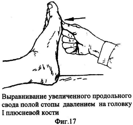 Способ и устройство для исправления дефектов стопы (патент 2301039)