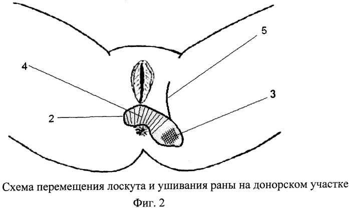 Перианальная складка где находится фото