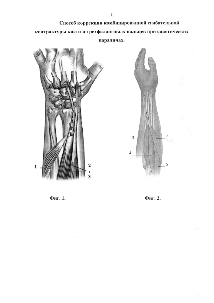 Способ коррекции комбинированной сгибательной контрактуры кисти и трехфаланговых пальцев при спастических параличах (патент 2648862)