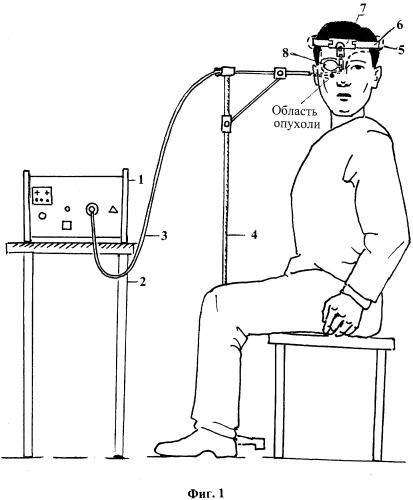 Установка для лечения опухолей кожи окологлазничной области (патент 2331446)