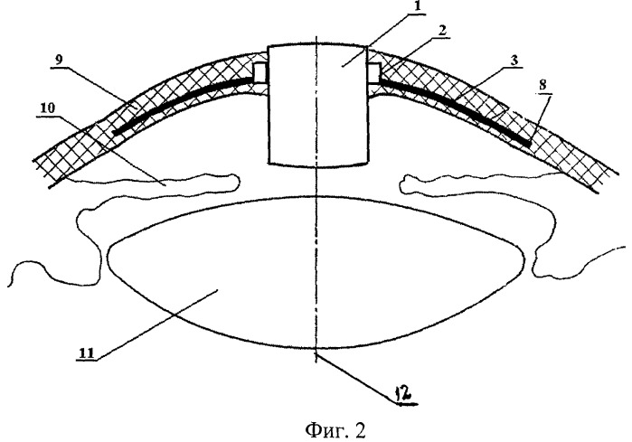 Кератопротез (патент 2481083)