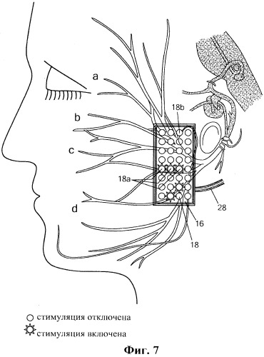 Система и способ стимуляции лицевого нерва (патент 2511082)