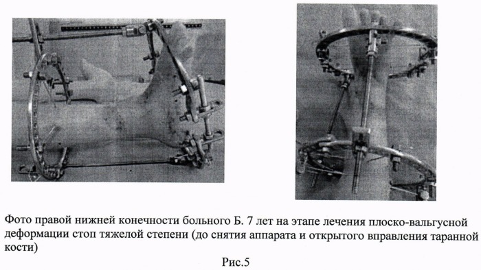 Способ лечения врожденной плоско-вальгусной деформации стоп тяжелой степени у детей с артрогрипозом (патент 2493793)
