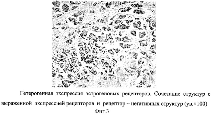 Способ прогнозирования течения заболевания раком молочной железы (патент 2300111)