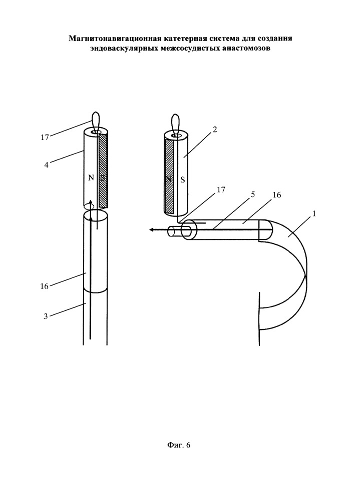 Магнитонавигационная катетерная система для создания эндоваскулярных межсосудистых анастомозов (патент 2662414)