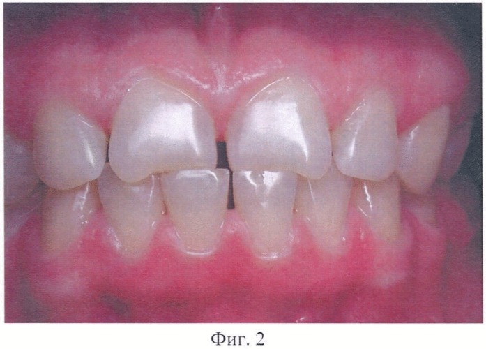 Способ восстановления коронковой части зубов, относящихся к группе резцов (патент 2441619)