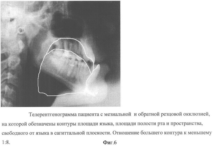 Способ диагностики аномалий зубочелюстной системы (патент 2360604)