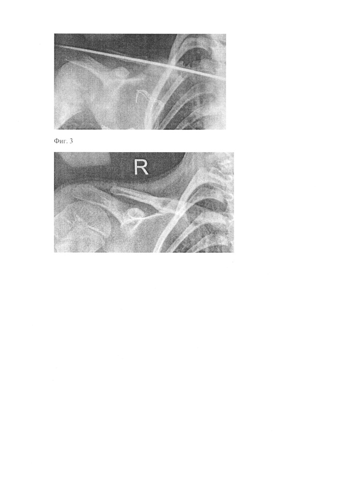 Способ лечения врожденного ложного сустава ключицы, образованного деформированными фрагментами ключицы у детей (патент 2651124)