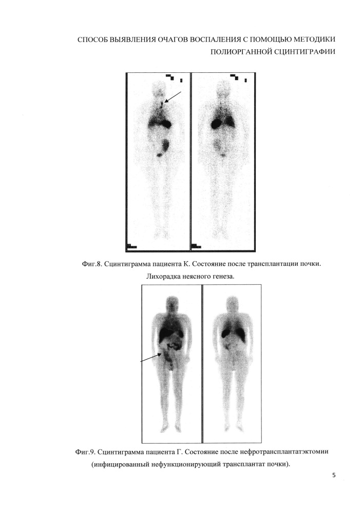 Способ выявления очагов воспаления с помощью методики полиорганной сцинтиграфии (патент 2648877)