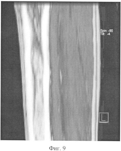 Способ прогнозирования перестройки дистракционного регенерата методом компьютерной томографии (патент 2342904)