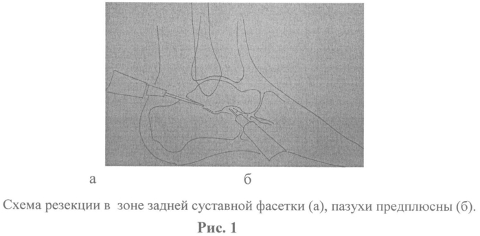 Малоинвазивный артродез подтаранного сустава (патент 2549297)