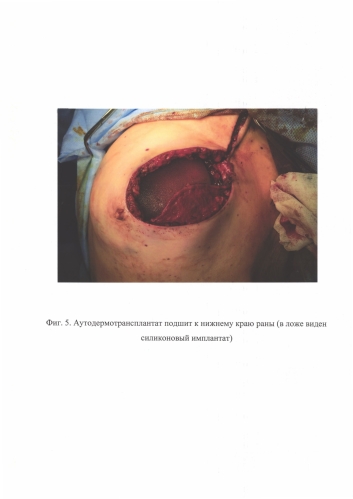 Способ профилактики экструзии силиконового имплантата после кожесохраняющей мастэктомии (патент 2591784)