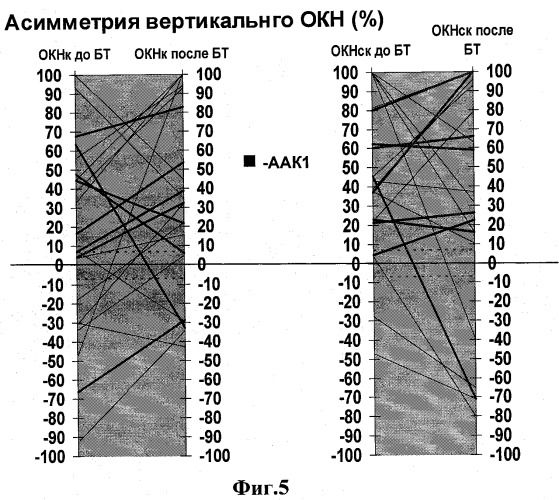 Способ диагностики аномалии арнольда-киари 1 у больных с кохлеовестибулярной дисфункцией (патент 2339295)