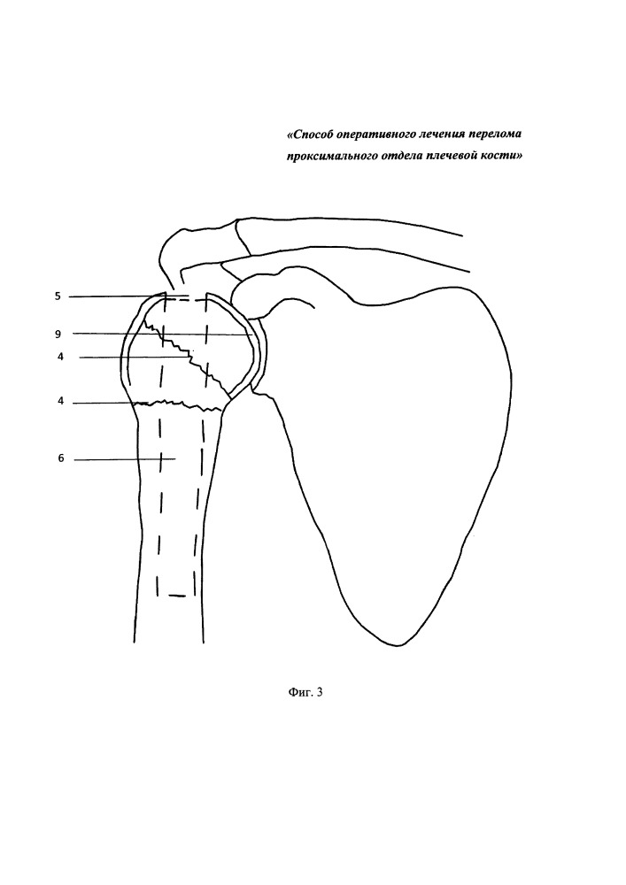 Способ хирургического лечения перелома проксимального отдела плечевой кости (патент 2652573)