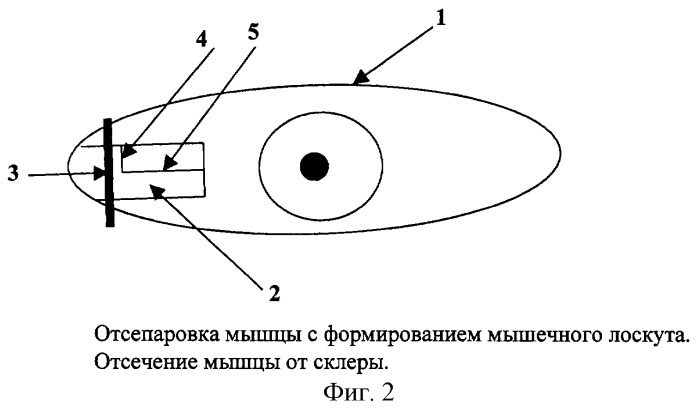 Способ лечения больших углов косоглазия (патент 2243750)