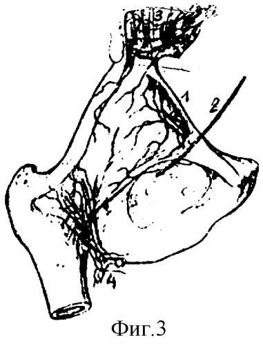Способ обезболивания тазобедренного сустава (патент 2281787)