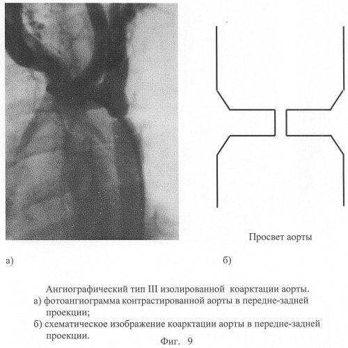 Способ диагностики изолированной коарктации аорты и способ выбора тактики ее лечения (патент 2244510)