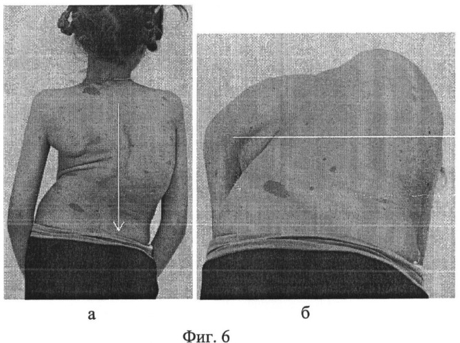Способ коррекции деформации позвоночника (патент 2506919)