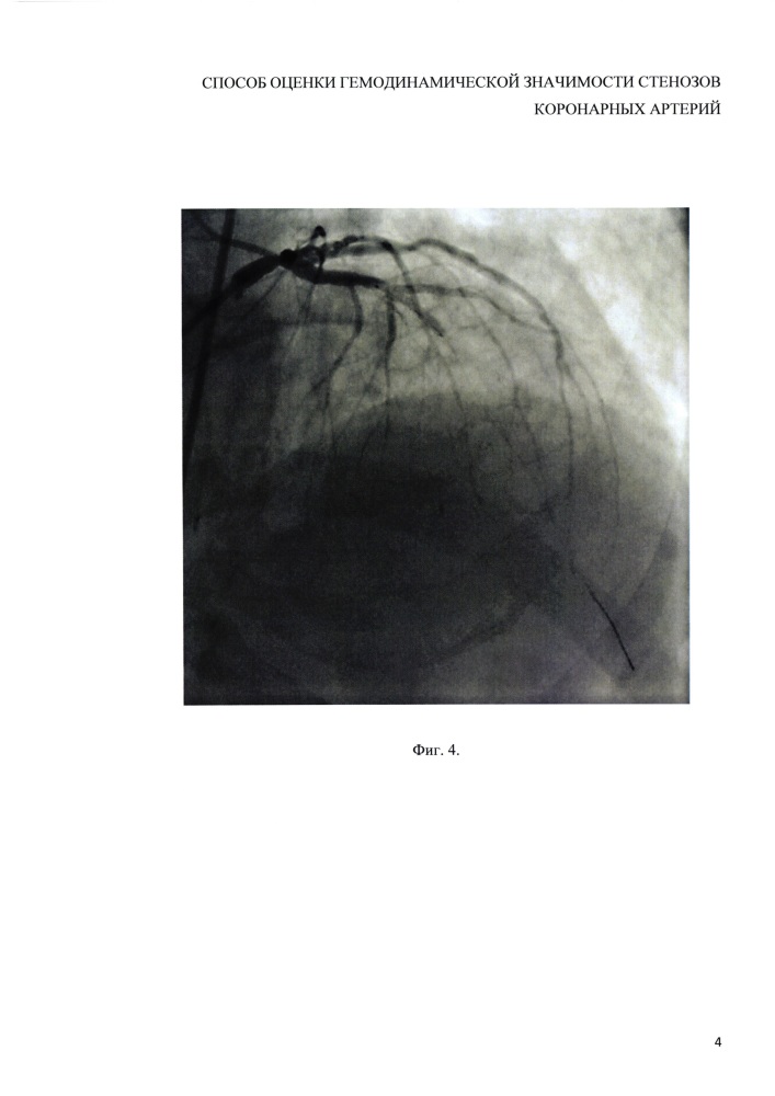 Способ оценки гемодинамической значимости стенозов коронарных артерий (ка) (патент 2622615)