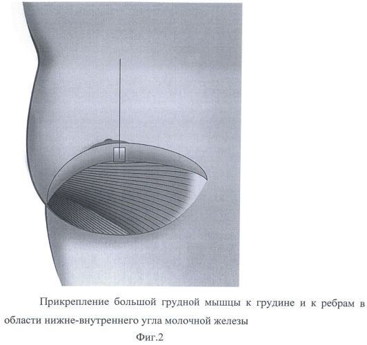 Способ формирования кармана для имплантата в двойственной плоскости при аугментационной маммопластике (патент 2501528)