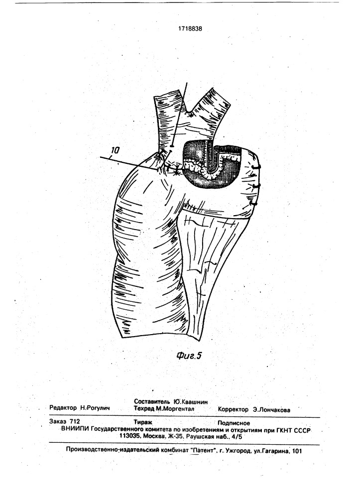 Способ формирования билиодигестивного анастомоза (патент 1718838)