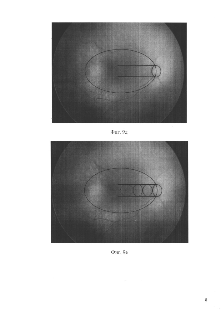 Способ определения локализации макулы при ретинопатии недоношенных (варианты) (патент 2645411)