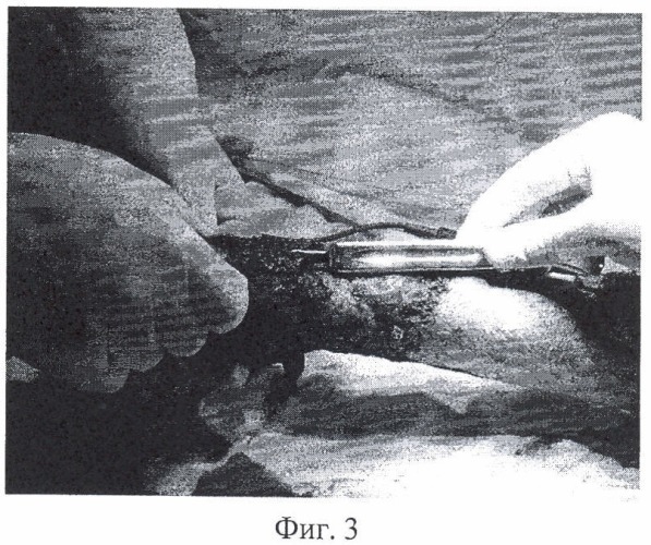 Инструмент для проведения некротомии при ожогах (патент 2402291)