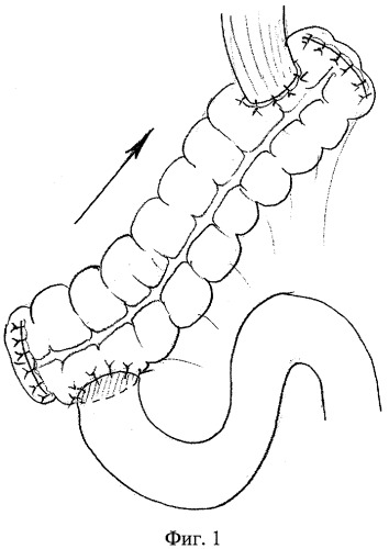 Способ толстокишечной гастропластики после гастрэктомии (патент 2278619)