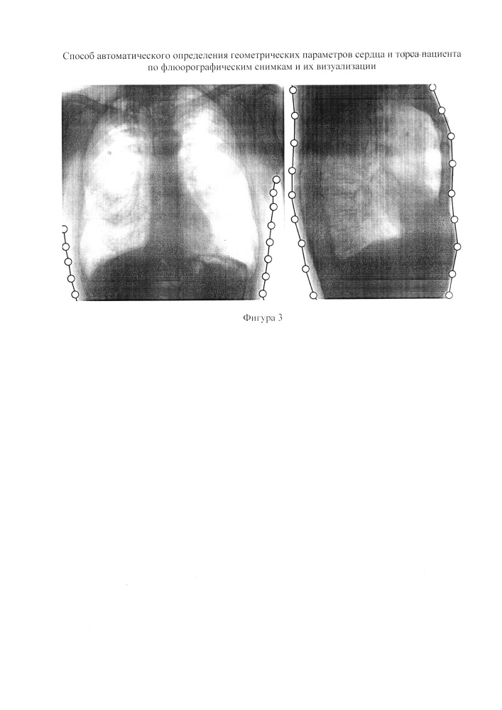 Способ автоматического определения геометрических параметров сердца и торса пациента по флюорографическим снимкам и их визуализации (патент 2639018)