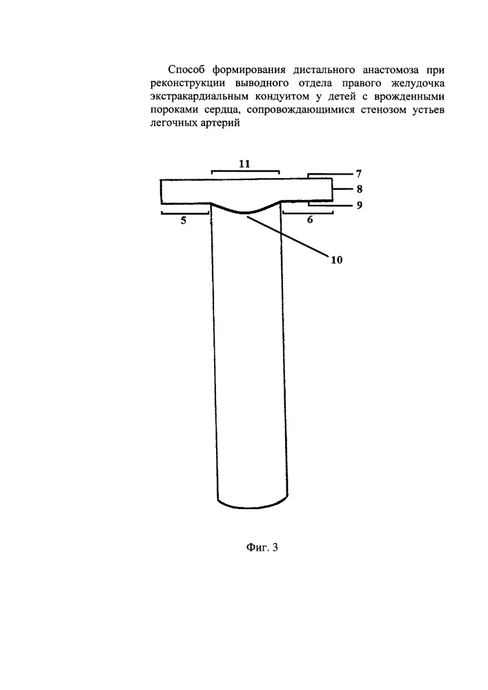 Способ формирования дистального анастомоза при реконструкции выводного отдела правого желудочка экстракардиальным кондуитом у детей с врожденными пороками сердца, сопровождающимися стенозом устьев легочных артерий (патент 2639030)