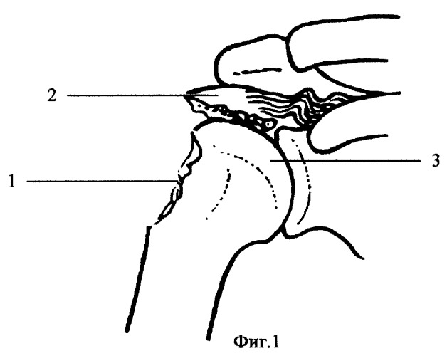 Способ хирургического лечения чрескостных разрывов сухожилий ротаторных мышц плеча (патент 2244522)