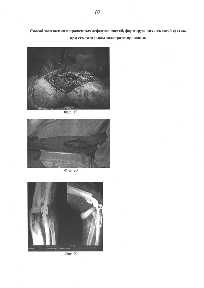 Способ замещения выраженных дефектов костей, формирующих локтевой сустав, при его тотальном эндопротезировании (патент 2662899)