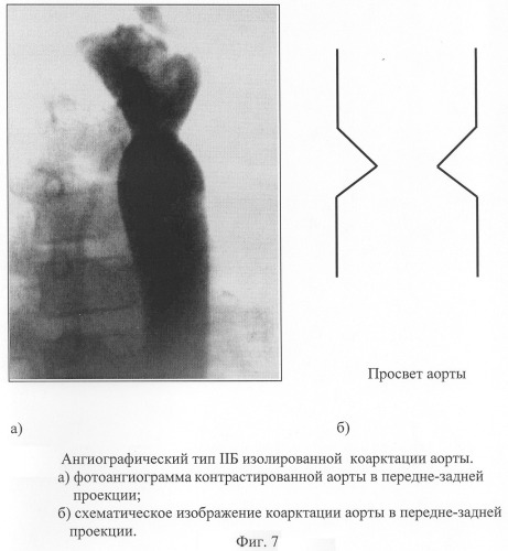 Способ диагностики изолированной коарктации аорты и способ выбора тактики ее лечения (патент 2244510)