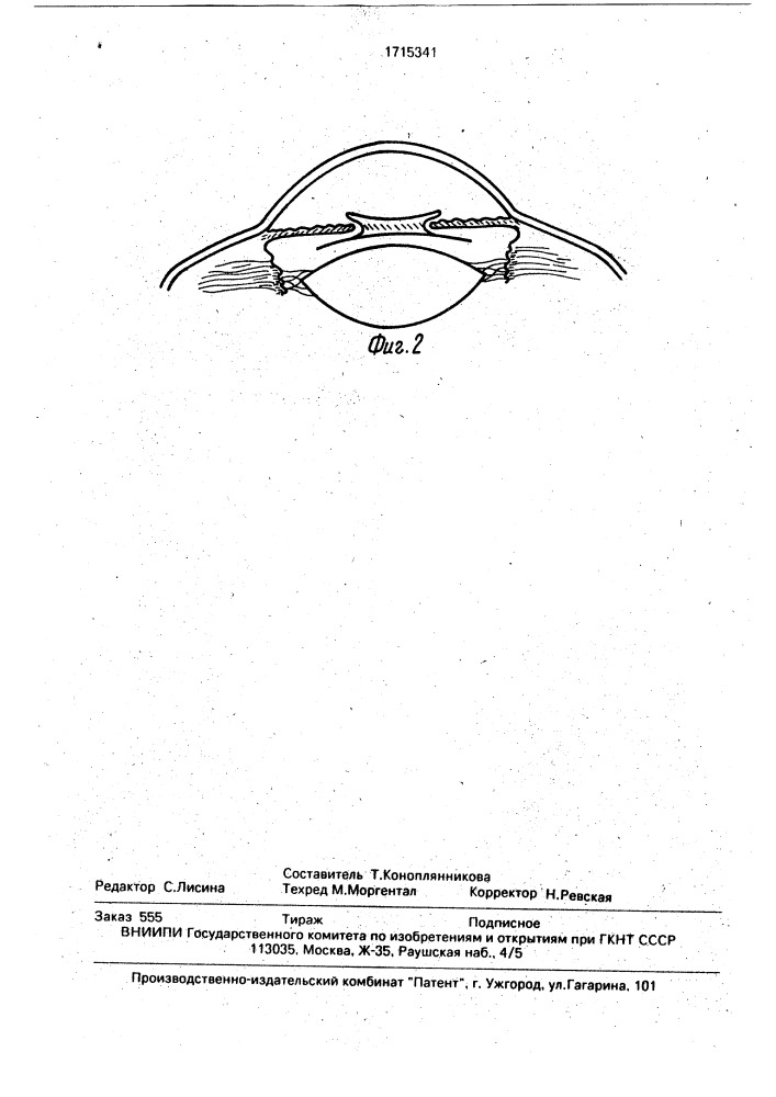Искусственный хрусталик глаза для имплантации в факичный глаз (патент 1715341)