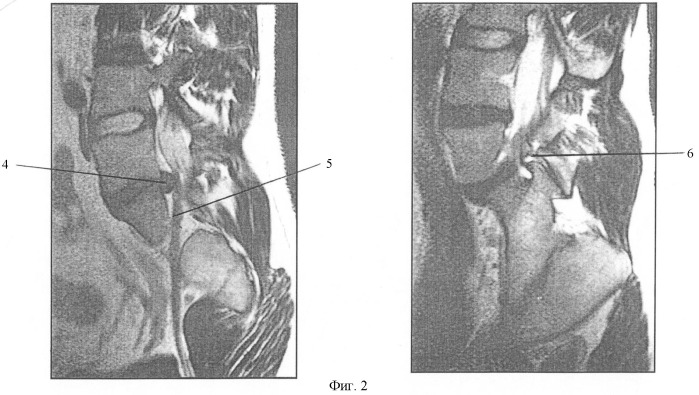 Способ выявления остеохондроза пояснично-крестцового отдела позвоночника (патент 2382603)