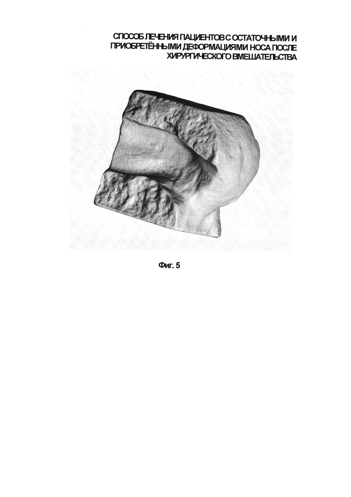 Способ лечения пациентов после хирургического вмешательства, выполненного по поводу остаточных и приобретённых деформаций носа (патент 2630130)
