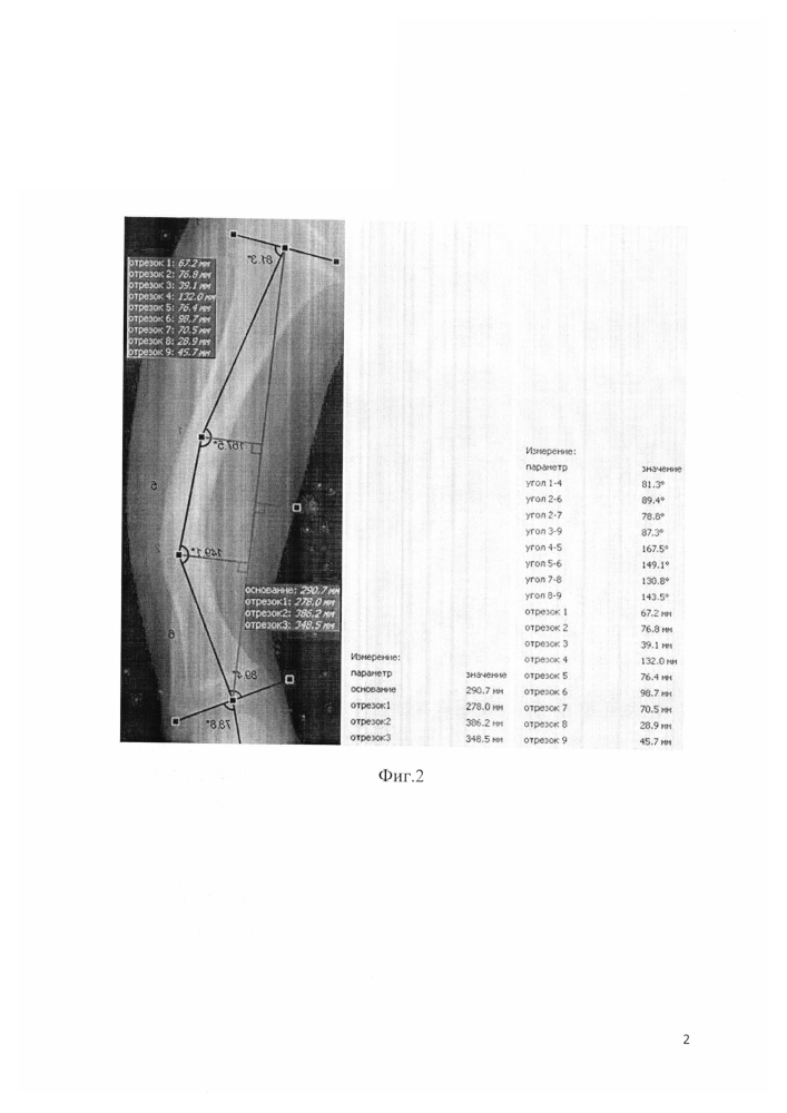 Способ оценки степени деформаций диафиза трубчатой кости и определения величины и уровня коррекции деформации для ее хирургического исправления (патент 2600070)