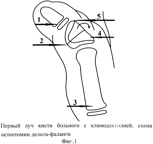 Способ оперативного лечения клинодактилии первого пальца кисти при акроцефалосиндактилии (патент 2546503)